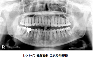 レントゲン撮影画像(2次元の情報)