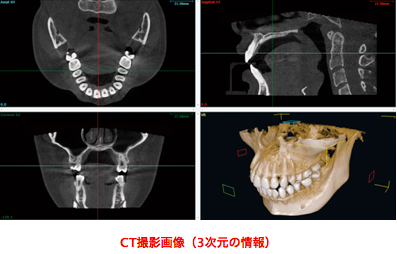 CT撮影画像(3次元の情報)