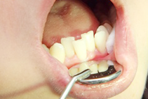 歯並びの悪い歯