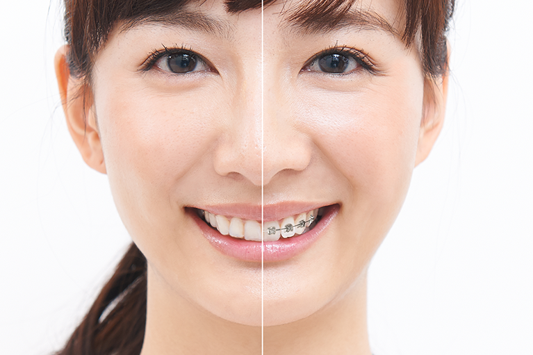 マウスピース型矯正装置